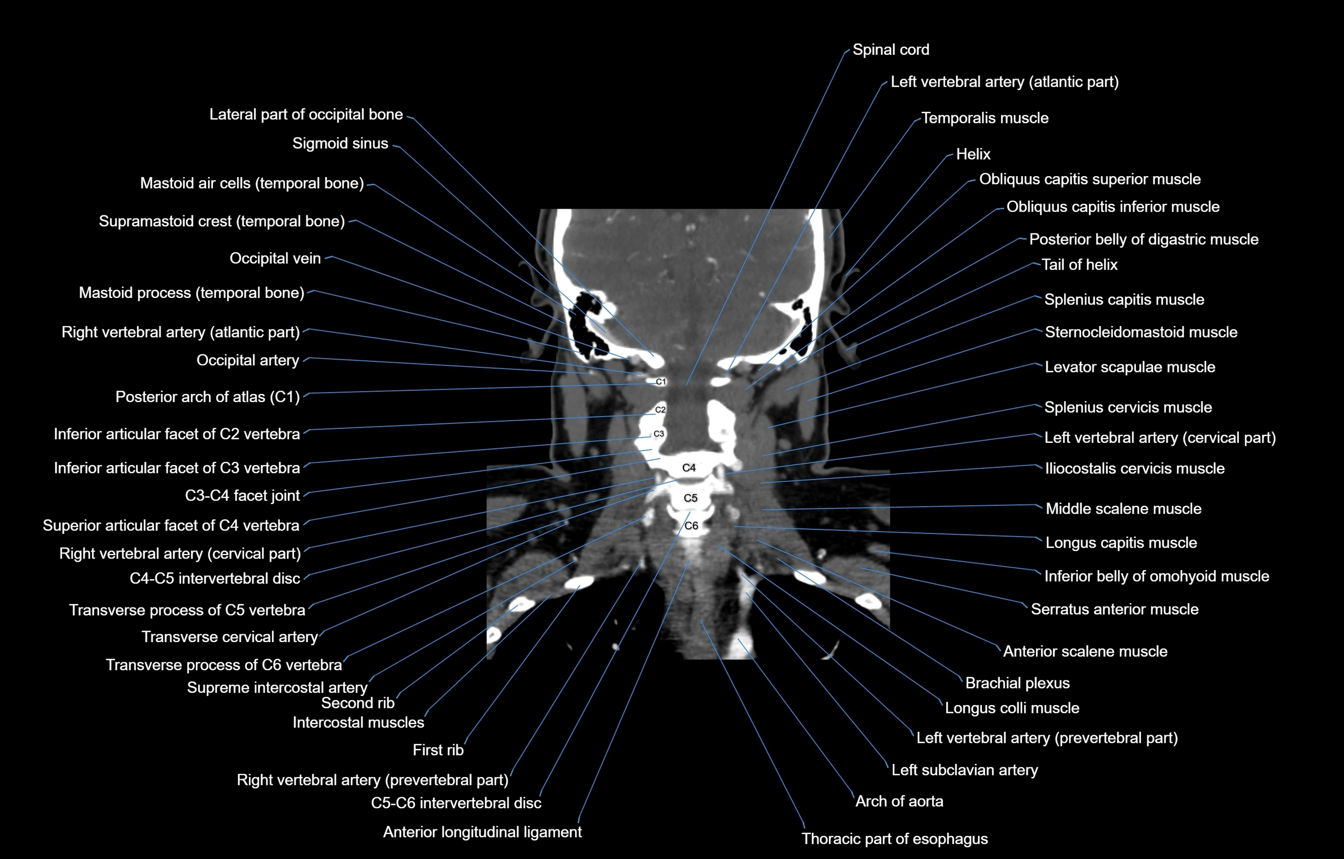 CT Neck coronal  cross sectional anatomy labelled 3D  radiology  image-00044.webp